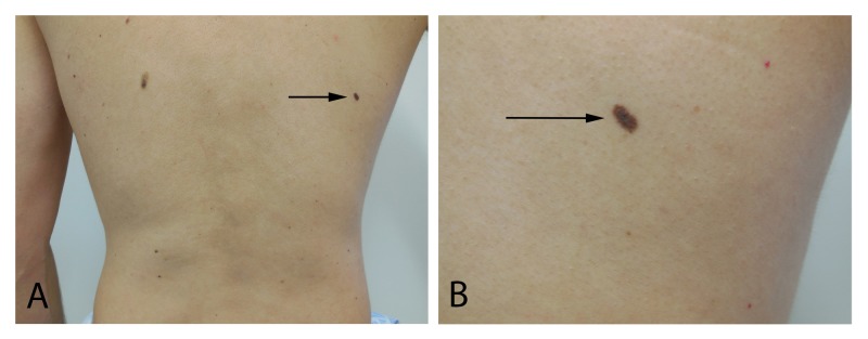 Vestibular Schwannoma Resection — Figure 2