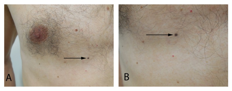 Vestibular Schwannoma Resection — Figure 3