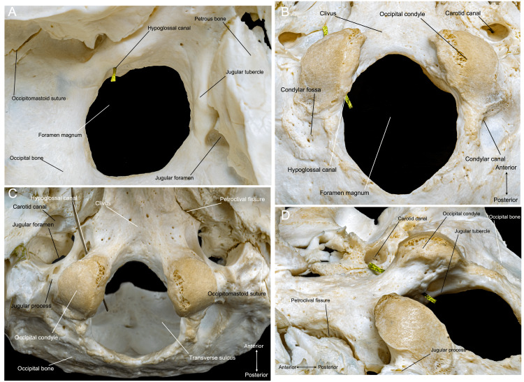 Anterior Cervical Approach — Figure 2