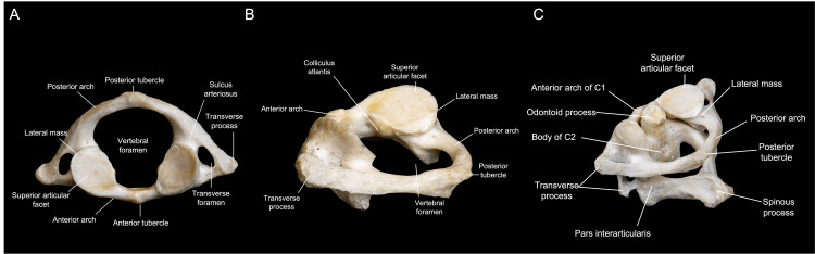Anterior Cervical Approach — Figure 3
