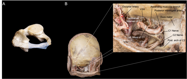Anterior Cervical Approach — Figure 6