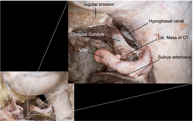 Anterior Cervical Approach — Figure 8