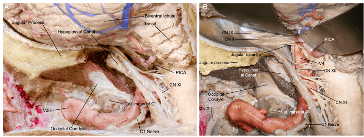 Anterior Cervical Approach — Figure 9