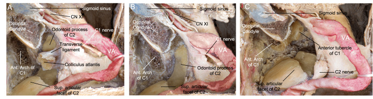 Anterior Cervical Approach — Figure 10