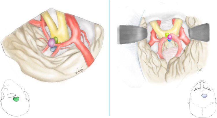 Anterior Interhemispheric Approach — Fig. 1