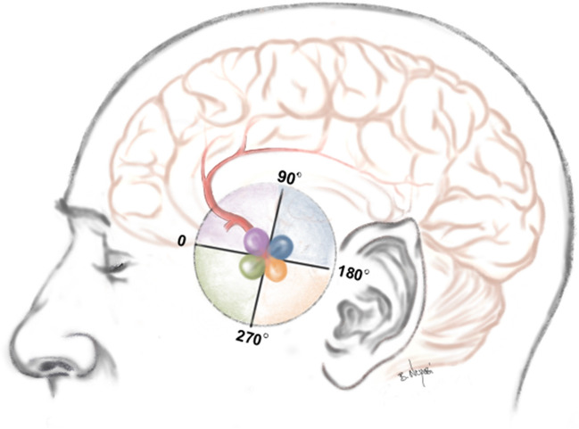 Anterior Interhemispheric Approach — Fig. 3