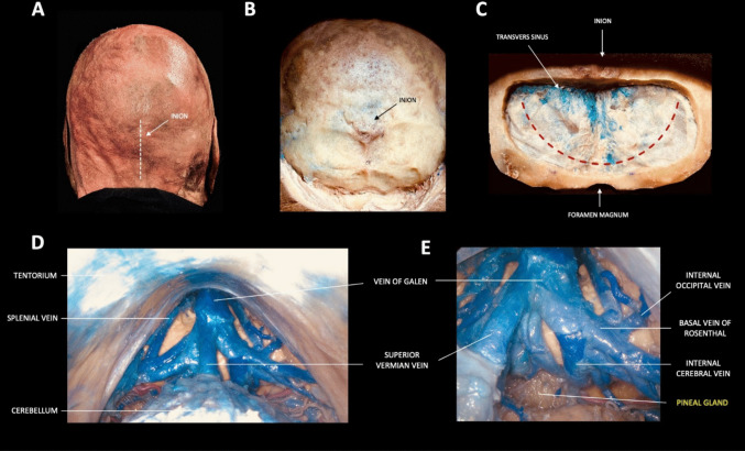 Anterior Interhemispheric Approach — Fig. 1