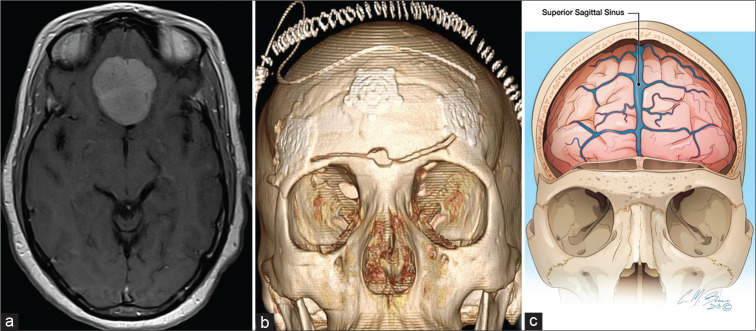 Bifrontal Craniotomy — Figure 1: