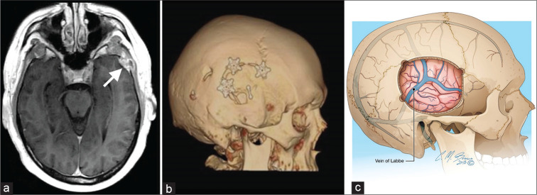 Bifrontal Craniotomy — Figure 2: