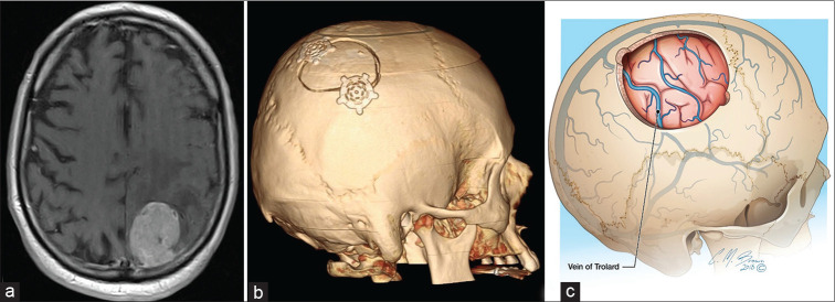 Bifrontal Craniotomy — Figure 3: