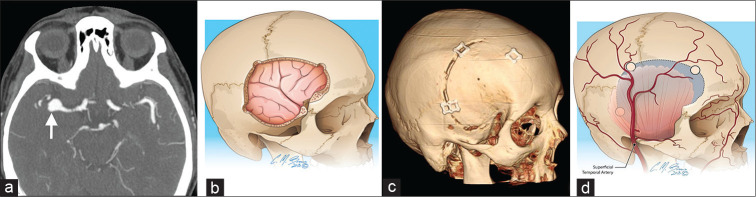 Bifrontal Craniotomy — Figure 4: