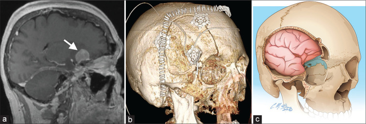Bifrontal Craniotomy — Figure 5:
