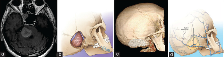 Bifrontal Craniotomy — Figure 6: