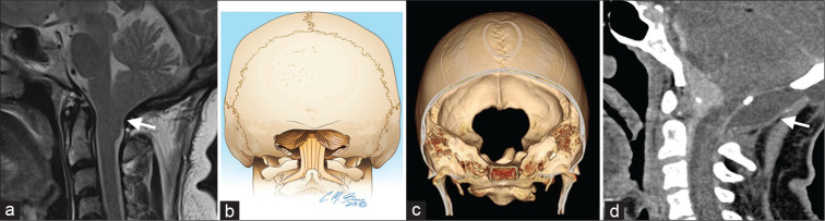 Bifrontal Craniotomy — Figure 7:
