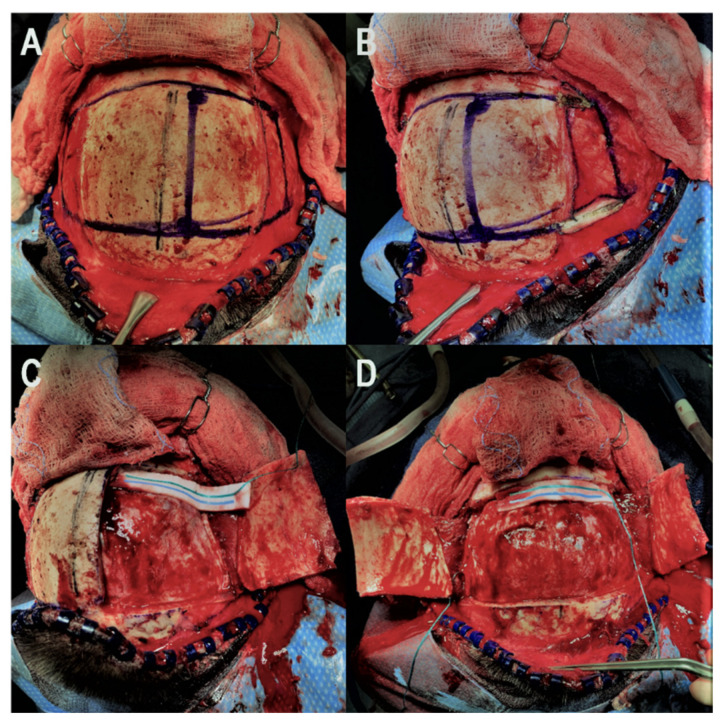 Bifrontal Craniotomy — Figure 1