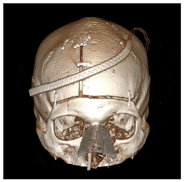 Bifrontal Craniotomy — Figure 2