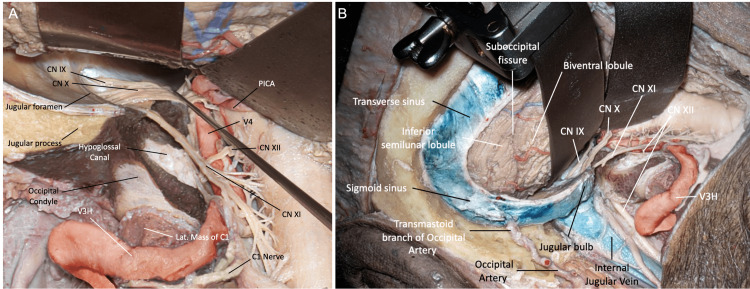 Far-Lateral Craniotomy — Figure 11