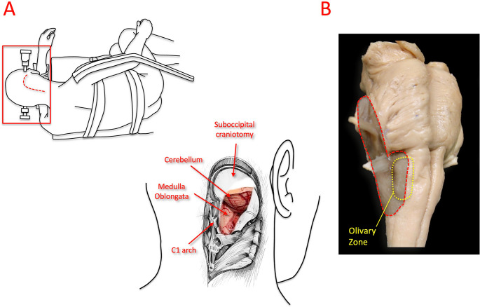 Far-Lateral Craniotomy — Fig. 1
