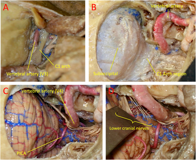 Far-Lateral Craniotomy — Fig. 2