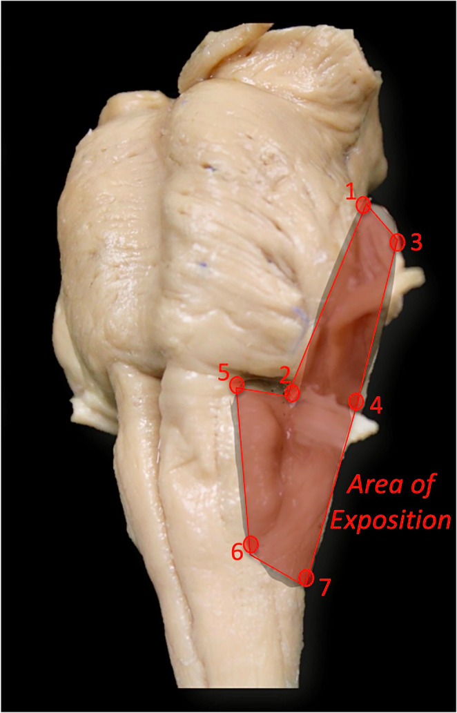 Far-Lateral Craniotomy — Fig. 3