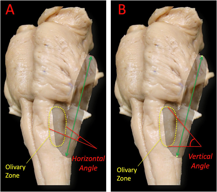 Far-Lateral Craniotomy — Fig. 4