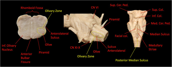 Far-Lateral Craniotomy — Fig. 5