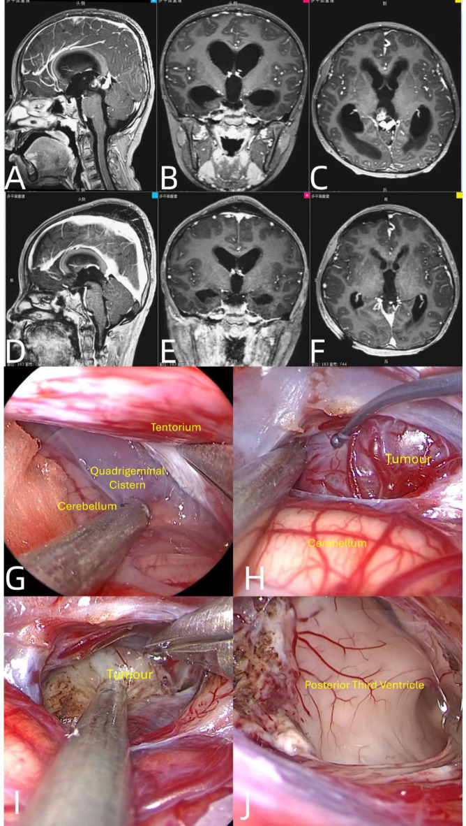 Far-Lateral Craniotomy — Fig. 1