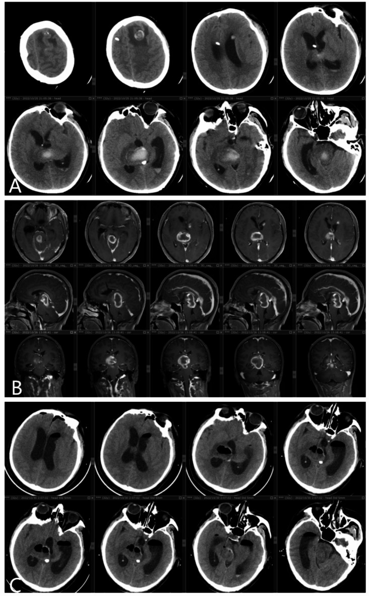 Far-Lateral Craniotomy — Fig. 2