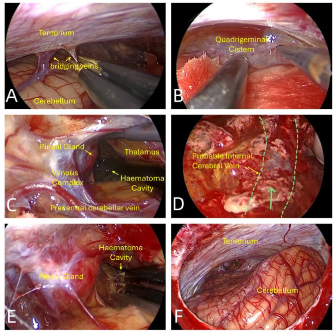 Far-Lateral Craniotomy — Fig. 3