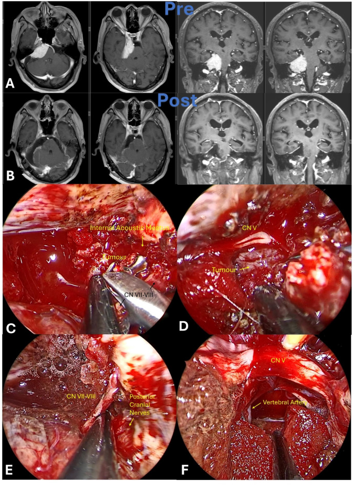 Far-Lateral Craniotomy — Fig. 4
