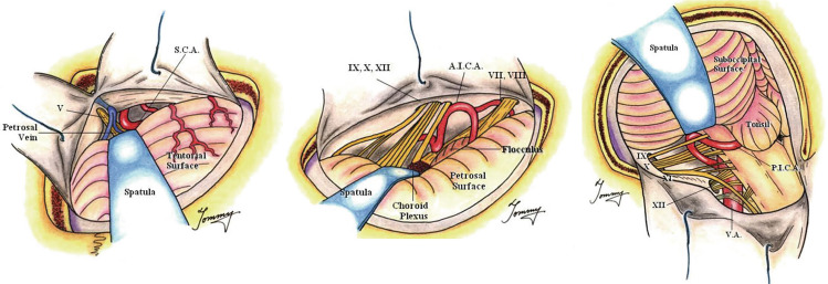 Microvascular Decompression Trigeminal Neuralgia — Rule of Three concept