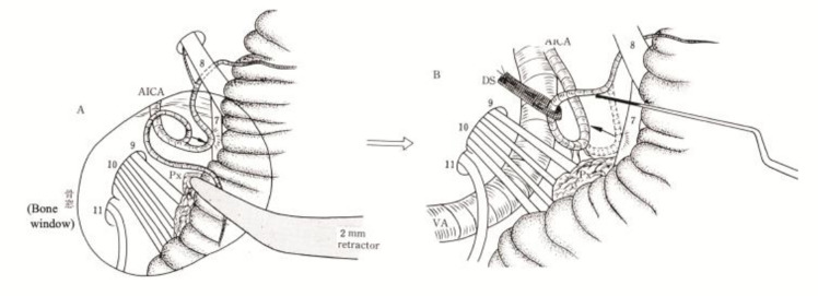 Microvascular Decompression Trigeminal Neuralgia — noncompressive transposition