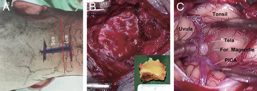 Midline Suboccipital Craniotomy — FIGURE 1