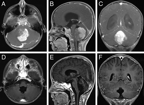 Midline Suboccipital Craniotomy — FIGURE 2