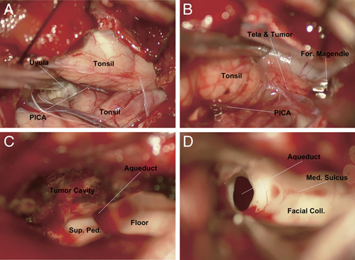 Midline Suboccipital Craniotomy — FIGURE 3