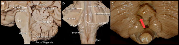 Midline Suboccipital Craniotomy — Fig. 1