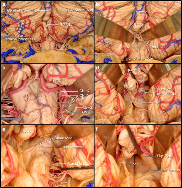 Midline Suboccipital Craniotomy — Fig. 2