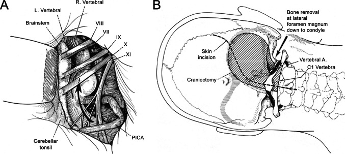 Midline Suboccipital Craniotomy — Fig. 2