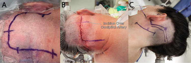 Midline Suboccipital Craniotomy — Fig. 3