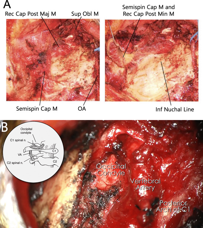 Midline Suboccipital Craniotomy — Fig. 4