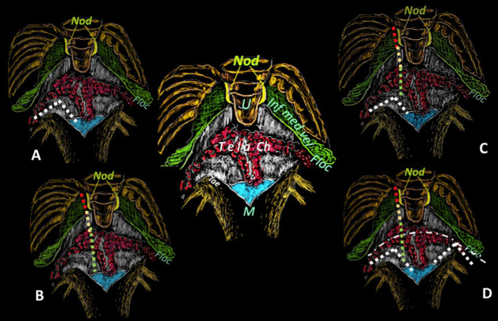 Midline Suboccipital Craniotomy — Telovelar surface map