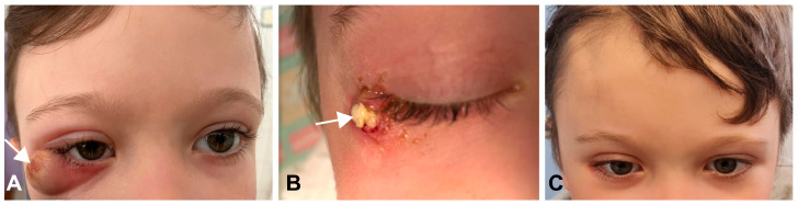Orbitozygomatic Craniotomy — Figure 1