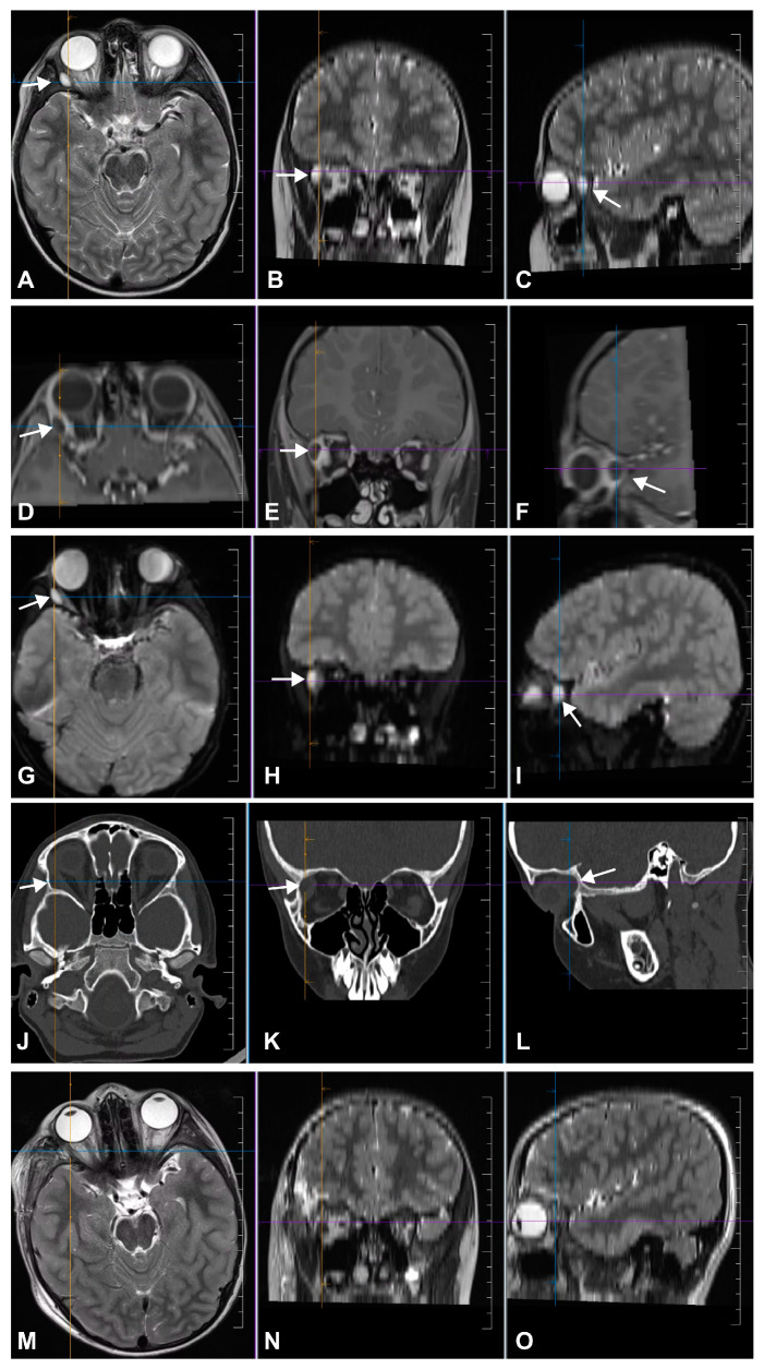 Orbitozygomatic Craniotomy — Figure 2