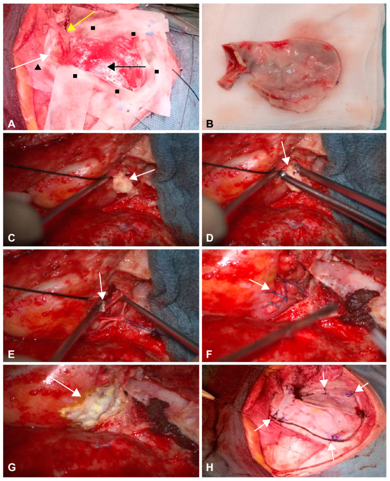 Orbitozygomatic Craniotomy — Figure 3