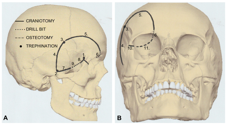 Orbitozygomatic Craniotomy — Figure 4