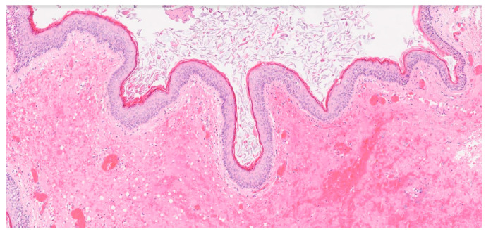Orbitozygomatic Craniotomy — Figure 5