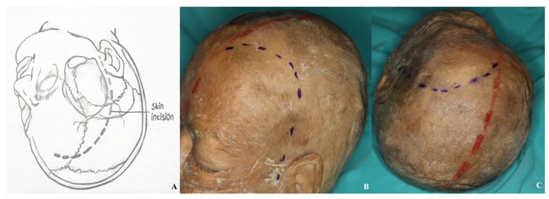 Orbitozygomatic Craniotomy — Figure 1