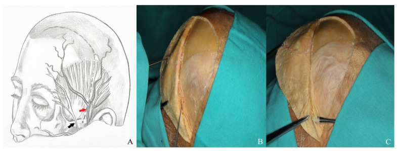 Orbitozygomatic Craniotomy — Figure 2