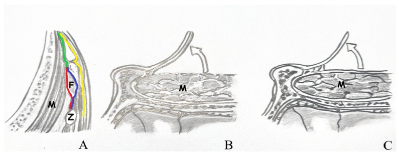 Orbitozygomatic Craniotomy — Figure 3
