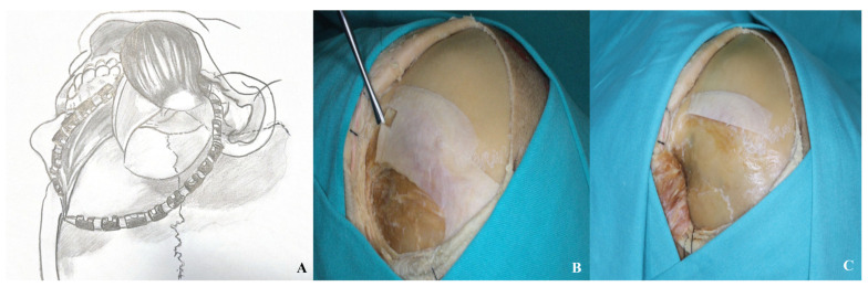 Orbitozygomatic Craniotomy — Figure 4